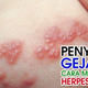 Illustration for article titled pengobatan herpes zosterem/em